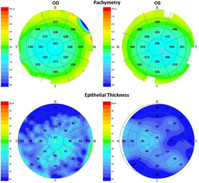 Assessment of corneal epithelial thickness mapping by spectral-domain optical coherence tomography